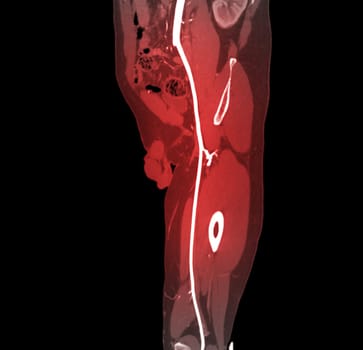 CTA femoral artery run off MPR curve showing Left femoral artery for diagnostic Acute or Chronic Peripheral Arterial Disease.