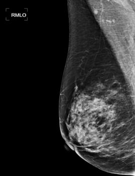 X-ray Digital Mammogram or mammography of both side breast showing benign tumor BI-RADS 2 should be checked once a year.