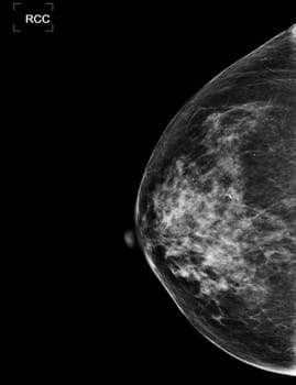 X-ray Digital Mammogram or mammography of both side breast showing benign tumor BI-RADS 2 should be checked once a year.