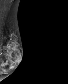 X-ray Digital Mammogram or mammography of both side breast showing benign tumor BI-RADS 2 should be checked once a year.