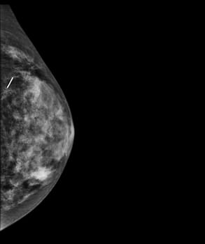 X-ray Digital Mammogram or mammography of both side breast showing benign tumor BI-RADS 2 should be checked once a year.