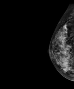 X-ray Digital Mammogram or mammography of both side breast showing benign tumor BI-RADS 2 should be checked once a year.