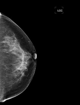 X-ray Digital Mammogram or mammography of both side breast showing benign tumor BI-RADS 2 should be checked once a year.