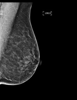 X-ray Digital Mammogram or mammography of both side breast showing Normal breast BI-RADS 1 should be checked once a year.