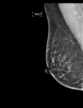 X-ray Digital Mammogram or mammography of both side breast showing Normal breast BI-RADS 1 should be checked once a year.