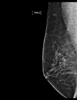 X-ray Digital Mammogram or mammography of both side breast showing benign tumor BI-RADS 2 should be checked once a year.