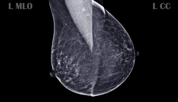 X-ray Digital Mammogram or mammography of Left Normal breast showing Normal breast BI-RADS 1 should be checked once a year.