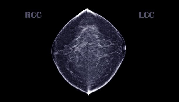 X-ray Digital Mammogram or mammography of both side breast CC View showing benign tumor BI-RADS 2 should be checked once a year.