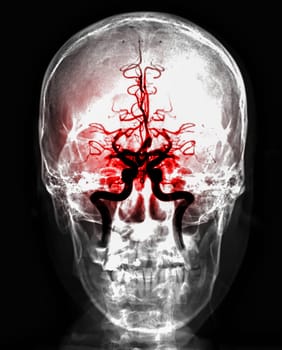 Skull image fusion with MRI MRA Brain for evaluate them stenosis and stroke disease.