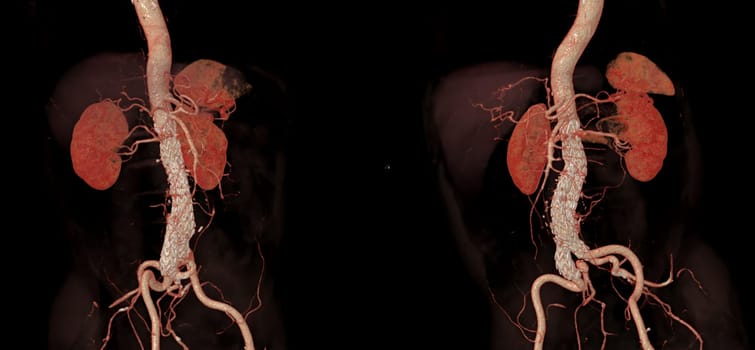 CTA whole aorta with Abdominal aorta stent graft compare 3D rendering image in case abdominal aortic aneurysms.