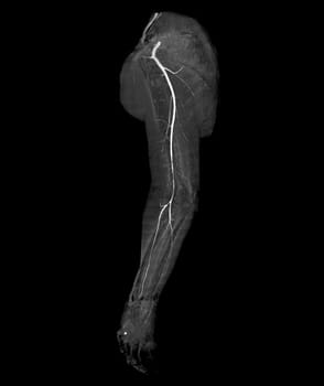 CTA brachial artery or CT scan of upper extremity 3D rendering image .