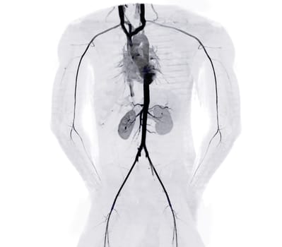 CTA whole aorta and brachial artery 3D rendering image in case patient tramatic.