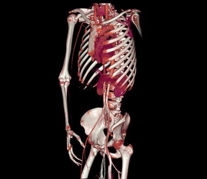 CTA whole aorta and brachial artery 3D rendering image in case patient tramatic.