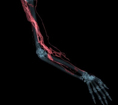 Brachial Arteries of the arm with Upper extremity Bone 3D rendering from CT Scanner.