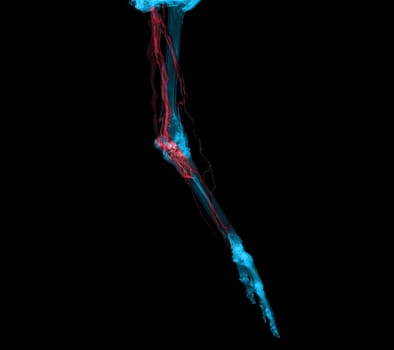 Brachial Arteries of the arm with Upper extremity Bone 3D rendering from CT Scanner.