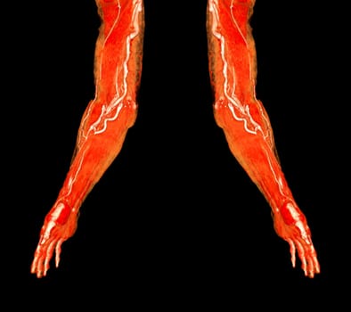 Brachial Arteries of the arm with Upper extremity Bone 3D rendering from CT Scanner.