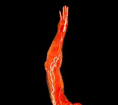 Brachial Arteries of the arm with Upper extremity Bone 3D rendering from CT Scanner.