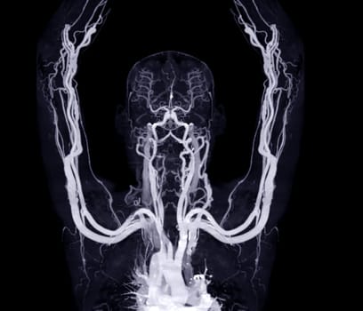 Brachial Arteries of the arm with Upper extremity Bone 3D rendering from CT Scanner.