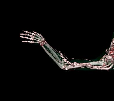 Brachial Arteries of the arm with Upper extremity Bone 3D rendering from CT Scanner.