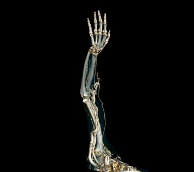 Brachial Arteries of the arm with Upper extremity Bone 3D rendering from CT Scanner.