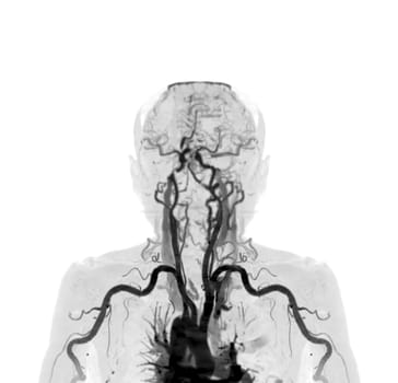 Brachial Arteries of the arm with Upper extremity Bone 3D rendering from CT Scanner.