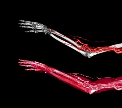 Brachial Arteries of the arm with Upper extremity Bone 3D rendering from CT Scanner.