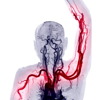 Brachial Arteries of the arm with Upper extremity Bone 3D rendering from CT Scanner.