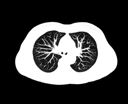 CT scan of Chest or lung axial view at radiology department in hospital. Covid-19 scan body xray test detection for covid virus epidemic spread concept