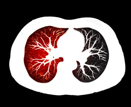 CT scan of Chest or lung axial view at radiology department in hospital. Covid-19 scan body xray test detection for covid virus epidemic spread concept