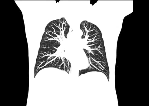 CT scan of Chest or lung coronal view at radiology department in hospital. Covid-19 scan body xray test detection for covid virus epidemic spread concept