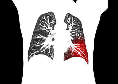 CT scan of Chest or lung coronal view at radiology department in hospital. Covid-19 scan body xray test detection for covid virus epidemic spread concept