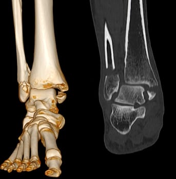 CT Scan ankle and foot or Computed Tomography of Ankle joint and Foot 3Drendering image showing fractured Tibia and fibula bone.