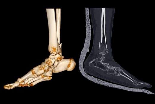 CT Scan ankle and foot or Computed Tomography of Ankle joint and Foot 3Drendering image showing fractured Tibia and fibula bone.