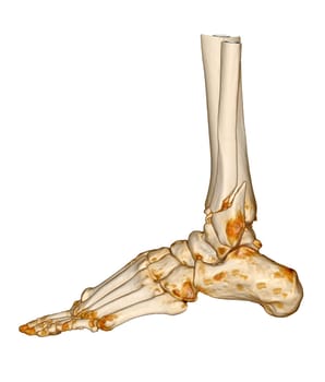 CT Scan ankle and foot or Computed Tomography of Ankle joint and Foot 3Drendering image showing fractured Tibia and fibula bone.