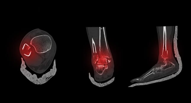 CT Scan ankle and foot or Computed Tomography of Ankle joint and Foot 3Drendering image showing fractured Tibia and fibula bone.