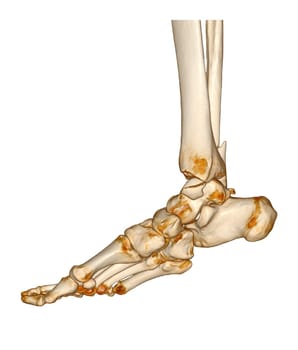 CT Scan ankle and foot or Computed Tomography of Ankle joint and Foot 3Drendering image showing fractured Tibia and fibula bone.