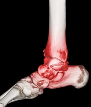 CT Scan ankle and foot or Computed Tomography of Ankle joint and Foot 3Drendering image showing fractured Tibia and fibula bone.
