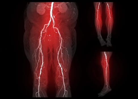 Collection of CTA femoral artery run off of femoral artery Presenting with Acute or Chronic Peripheral Arterial Disease.