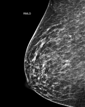 X-ray Digital Mammogram or mammography of both side breast Standard views are mediolateral oblique (MLO) views for screening Breast cancer and evidence of malignancy .