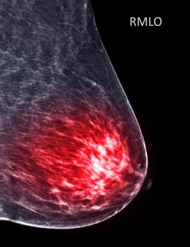 X-ray Digital Mammogram or mammography of both side breast Standard views are mediolateral oblique (MLO) views for screening Breast cancer and evidence of malignancy .