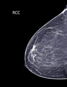 X-ray Digital Mammogram or mammography of both side breast Standard views are bilateral craniocaudal (CC) for screening Breast cancer and evidence of malignancy .