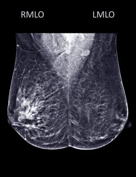 X-ray Digital Mammogram or mammography of both side breast Standard views are mediolateral oblique (MLO) views for screening Breast cancer and evidence of malignancy .