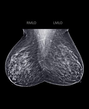 X-ray Digital Mammogram or mammography of both side breast Standard views are mediolateral oblique (MLO) views for screening Breast cancer and evidence of malignancy .