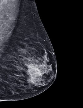 X-ray Digital Mammogram or mammography of both side breast Standard views are mediolateral oblique (MLO) views for screening Breast cancer and evidence of malignancy .