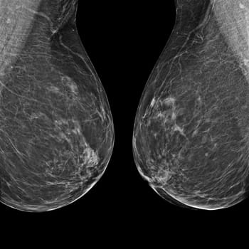 X-ray Digital Mammogram or mammography of both side breast Standard views are mediolateral oblique (MLO) views for screening Breast cancer and evidence of malignancy .