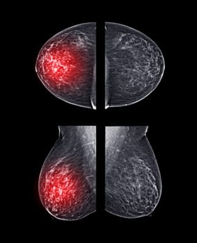 X-ray Digital Mammogram or mammography of both side breast CC view and MLO for screening Breast cancer and evidence of malignancy .