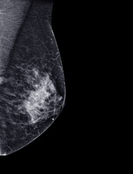 X-ray Digital Mammogram or mammography of both side breast Standard views are mediolateral oblique (MLO) views for screening Breast cancer and evidence of malignancy .