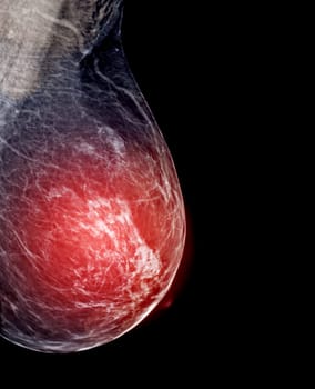 X-ray Digital Mammogram or mammography of both side breast Standard views are mediolateral oblique (MLO) views for screening Breast cancer and evidence of malignancy .