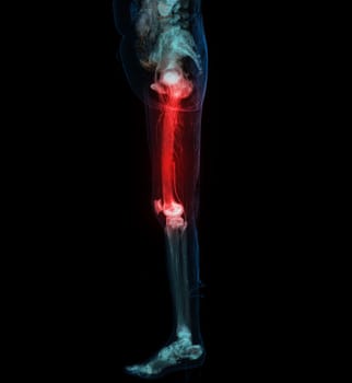 CT scan of lower extremity ,3D illustration of Femur bone , knee joint , leg and foot .
