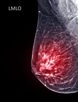 X-ray Digital Mammogram or mammography of both side breast Standard views are mediolateral oblique (MLO) views for screening Breast cancer and evidence of malignancy .